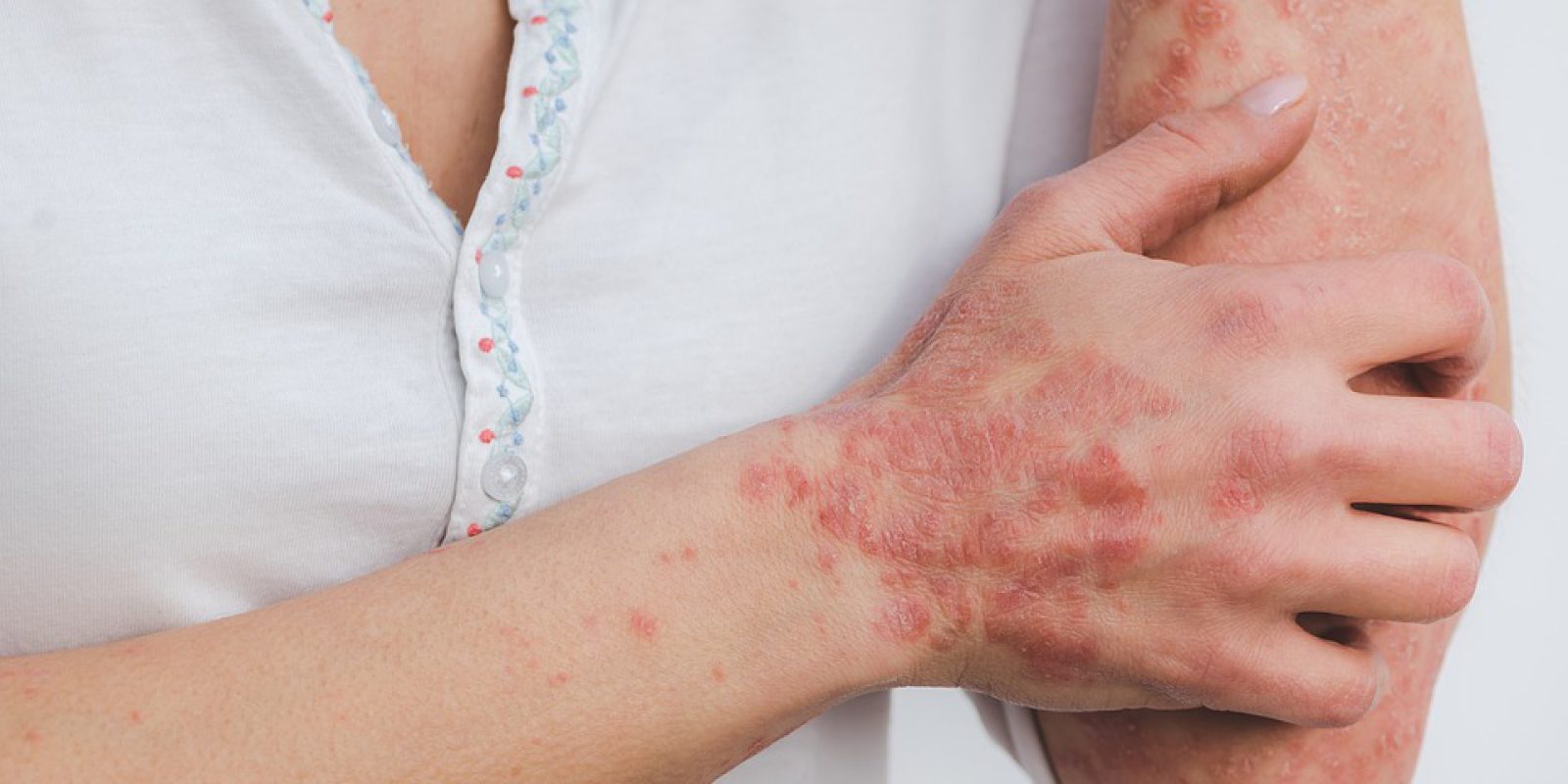 psoriasis-5996424_960_720