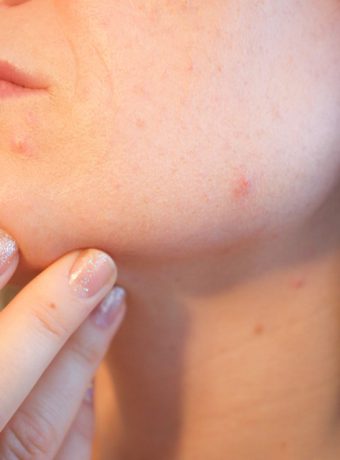 acne-1606765_960_720